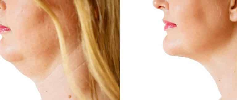 طرق بسيطة للتخلص من دهون الرقبة