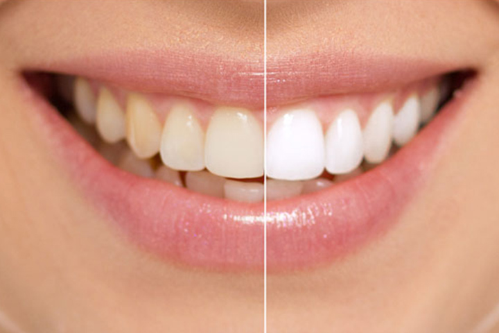 كيفية استخدام بيكربونات الصوديوم لتبييض الأسنان