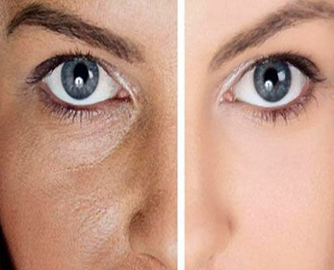 طرق طبيعية لعلاج المسام المفتوحة