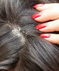 وصفات طبيعية لعلاج قشرة الشعر فى المنزل