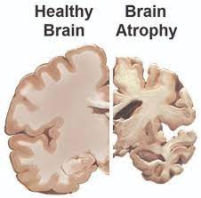 كم يعيش مريض ضمور المخ