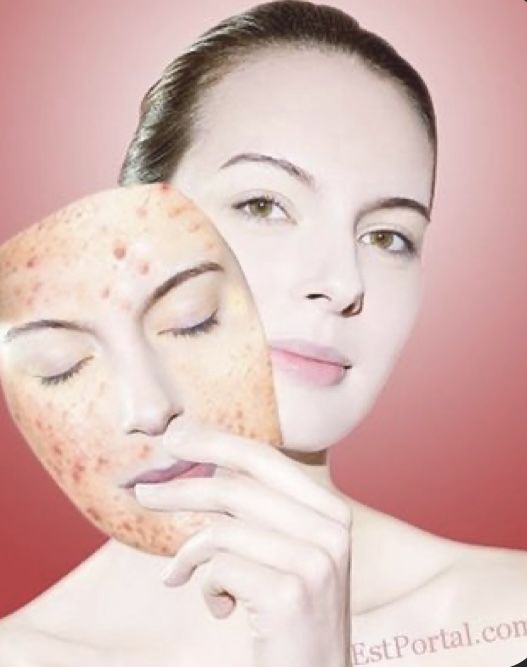 علاج الحبوب في الوجه بالأعشاب والطرق الطبيعية