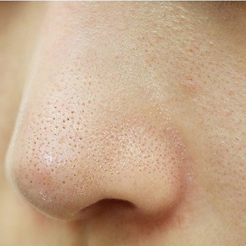 كيف أزيل الرؤوس السوداء من الأنف في البيت؟